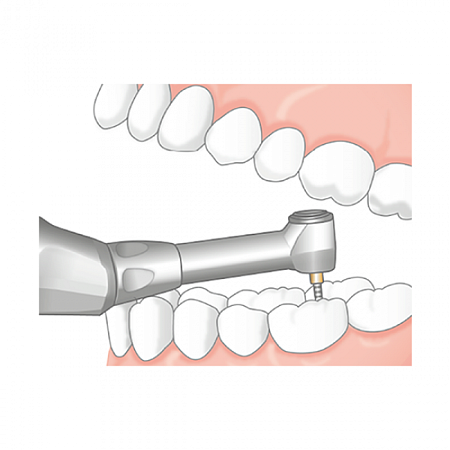 NSK Endo-Mate TC2 MPA - беспроводной эндодонтический микромотор с возможностью быстрого подключения апекслокатора